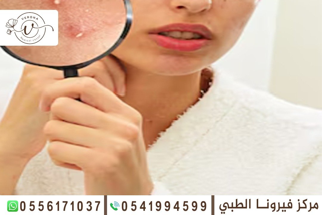 علاج مشاكل البشرة في الشارقة